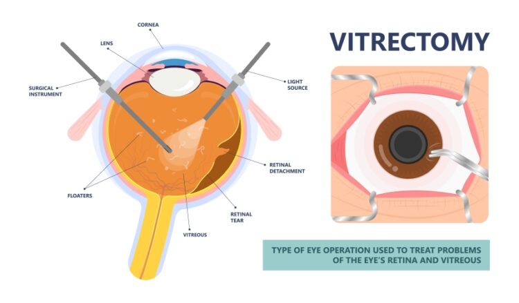 vitrectomy-altoona-eye-surgery-brookville-pa-laurel-eye-clinic-dubois